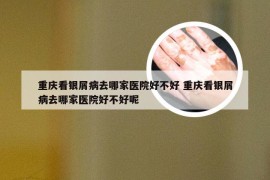 重庆看银屑病去哪家医院好不好 重庆看银屑病去哪家医院好不好呢