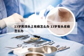 13岁男孩头上有癣怎么办 13岁有头皮癣怎么办