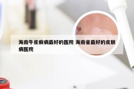 海南牛皮癣病最好的医院 海南省最好的皮肤病医院