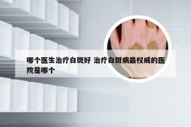 哪个医生治疗白斑好 治疗白斑病最权威的医院是哪个