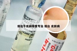 烟台牛皮癣哪里专治 烟台 皮肤病