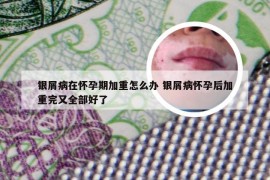 银屑病在怀孕期加重怎么办 银屑病怀孕后加重完又全部好了