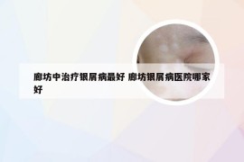 廊坊中治疗银屑病最好 廊坊银屑病医院哪家好