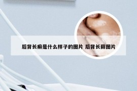 后背长癣是什么样子的图片 后背长藓图片