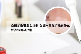 白斑扩散要怎么控制 白斑一直在扩散有什么好办法可以控制