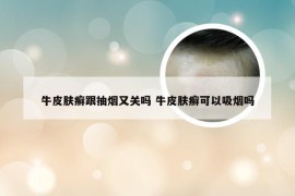 牛皮肤癣跟抽烟又关吗 牛皮肤癣可以吸烟吗