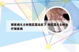 银屑病凡士林西瓜霜治愈了 西瓜霜凡士林治疗银屑病