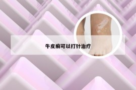 牛皮癣可以打针治疗