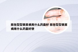 脓包型型银屑病用什么药最好 脓包型型银屑病用什么药最好使