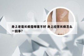 身上老是长癣是哪里不好 身上经常长癣怎么一回事?