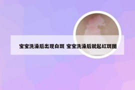 宝宝洗澡后出现白斑 宝宝洗澡后就起红斑图