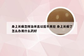 身上长癣怎样治并且以后不再犯 身上长癣了怎么办用什么药好