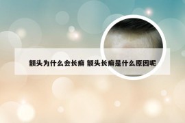 额头为什么会长癣 额头长癣是什么原因呢