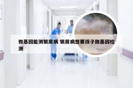 微基因能测银屑病 银屑病想要孩子做基因检测