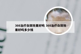 308治疗白斑效果好吗 308治疗白斑效果好吗多少钱