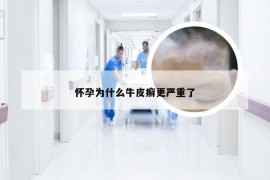 怀孕为什么牛皮癣更严重了