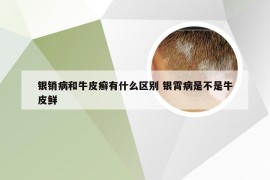 银销病和牛皮癣有什么区别 银霄病是不是牛皮鲜