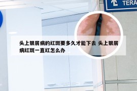 头上银屑病的红斑要多久才能下去 头上银屑病红斑一直红怎么办