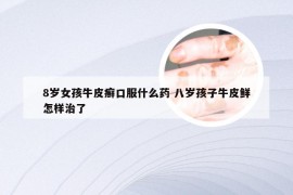 8岁女孩牛皮癣口服什么药 八岁孩子牛皮鲜怎样治了