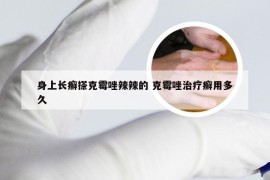 身上长癣搽克霉唑辣辣的 克霉唑治疗癣用多久