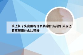 头上长了头皮癣吃什么药涂什么药好 头皮上有皮癣用什么比较好