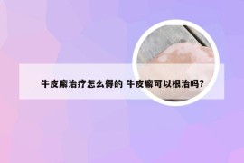 牛皮廨治疗怎么得的 牛皮廨可以根治吗?