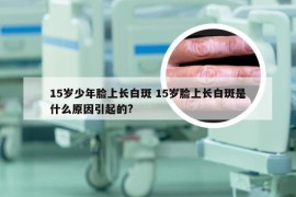 15岁少年脸上长白斑 15岁脸上长白斑是什么原因引起的?