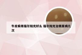 牛皮癣用福尔阳光好么 福尔阳光治银屑病几次