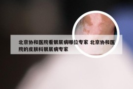 北京协和医院看银屑病哪位专家 北京协和医院的皮肤科银屑病专家