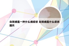 白斑病是一种什么病症状 白斑病是什么症状图片