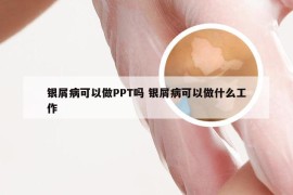 银屑病可以做PPT吗 银屑病可以做什么工作