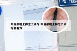 银屑病晚上痒怎么止痒 银屑病晚上痒怎么止痒最有效