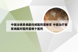 中国治银屑病最权威医院是哪家 中国治疗银屑病最好医院是哪个医院