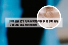 脖子后面起了几块白斑是咋回事 脖子后面起了几块白斑是咋回事图片