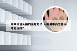 中草药治头癣的治疗方法 头癣用中药怎样治才能治好?