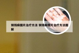 铜钱癣图片治疗方法 铜钱癣图片治疗方法图解