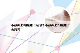 小孩身上有癣用什么药好 小孩身上长癣用什么药膏