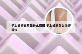 手上长癣克星是什么原因 手上长癣怎么治好得快