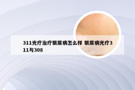 311光疗治疗银屑病怎么样 银屑病光疗311与308