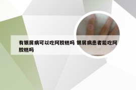 有银屑病可以吃阿胶糕吗 银屑病患者能吃阿胶糕吗