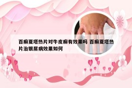 百癣夏塔热片对牛皮癣有效果吗 百癣夏塔热片治银屑病效果如何