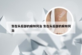 生在头后部的癣如何治 生在头后部的癣如何治