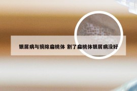 银屑病与摘除扁桃体 割了扁桃体银屑病没好