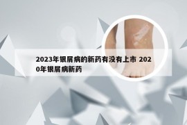 2023年银屑病的新药有没有上市 2020年银屑病新药