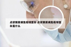 点状银屑病免疫球蛋白 点状银屑病免疫球蛋白是什么