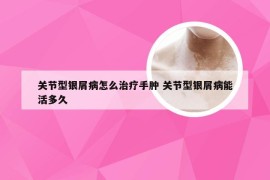 关节型银屑病怎么治疗手肿 关节型银屑病能活多久