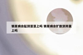 银屑病会起到蛋蛋上吗 银屑病会扩散到阴囊上吗