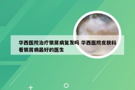 华西医院治疗银屑病复发吗 华西医院皮肤科看银屑病最好的医生