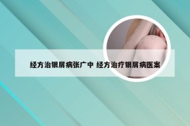 经方治银屑病张广中 经方治疗银屑病医案