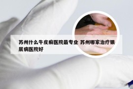 苏州什么牛皮癣医院最专业 苏州哪家治疗银屑病医院好